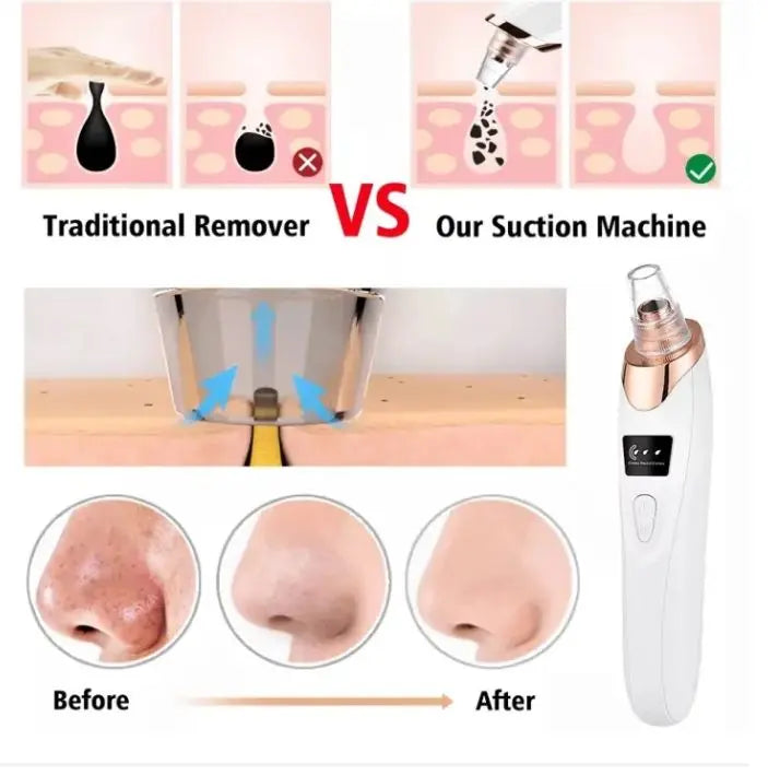 Herbal Glow Derma Suction – Instant Blackhead Remover Herbal Glow